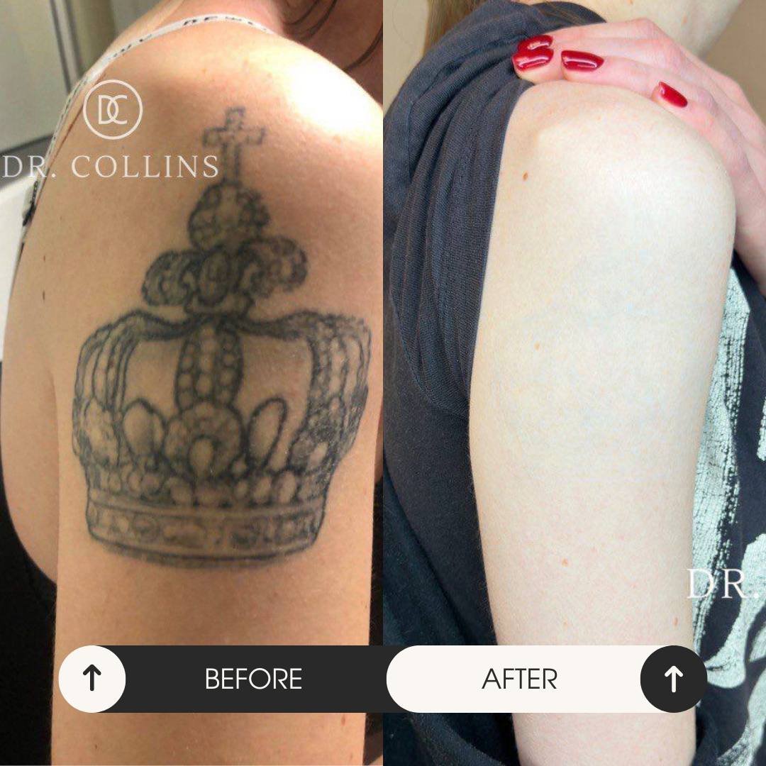 Приклад результатів до/після видалення тату